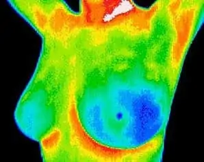 Thermography Breast Scan