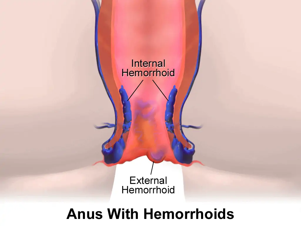 Internal and External Hemorrhoids - CBD For Hemorrhoids